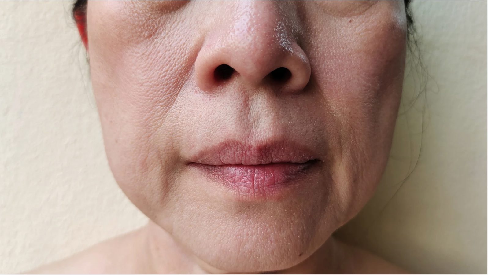 sagging jowls and cheeks